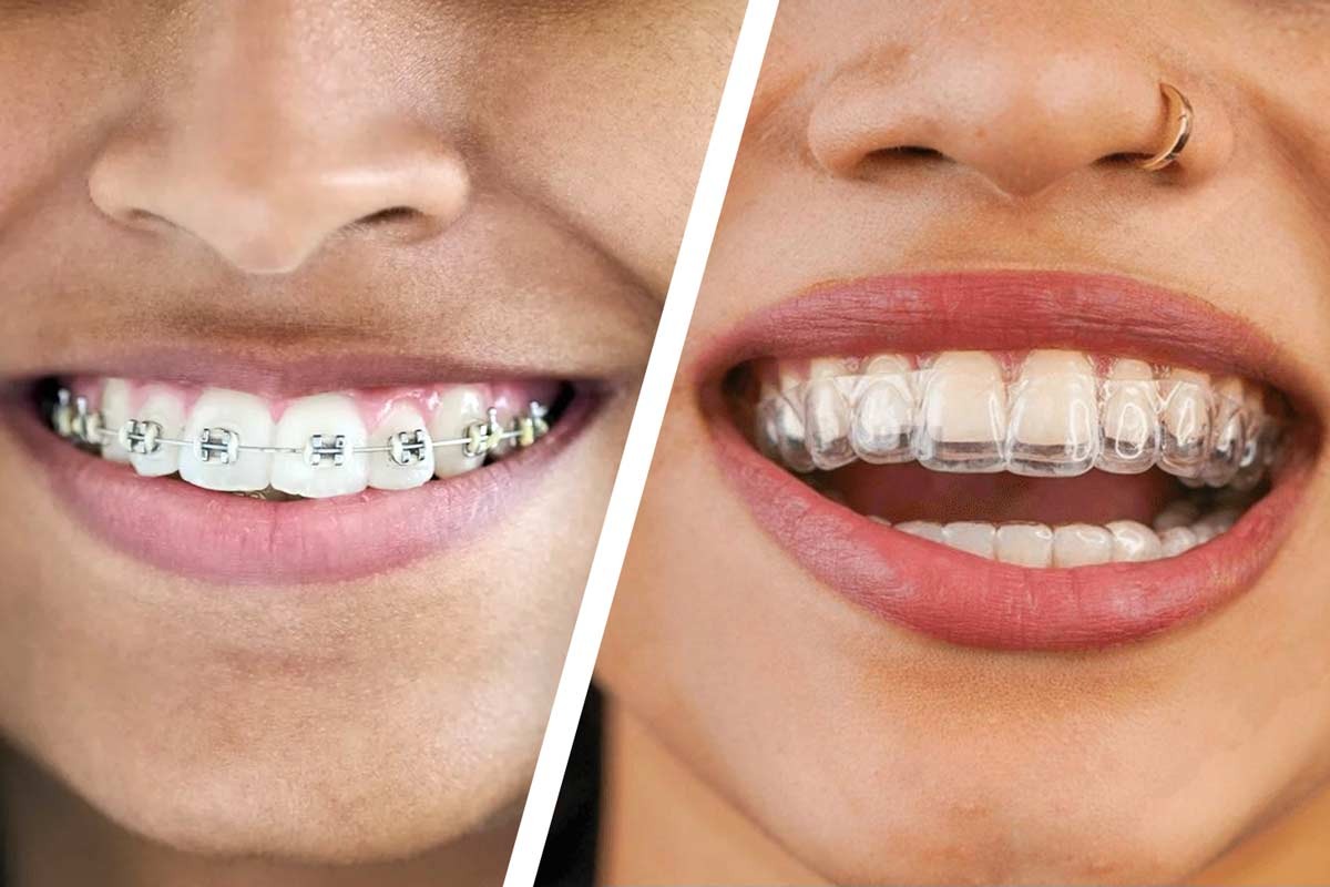 Invisalign Teeth Straightening