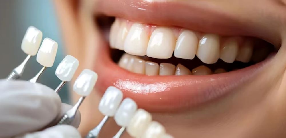 veneers dentist near me