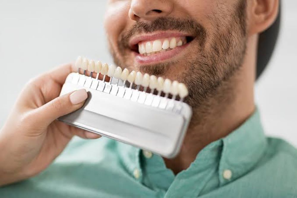 veneers Agoura Hills